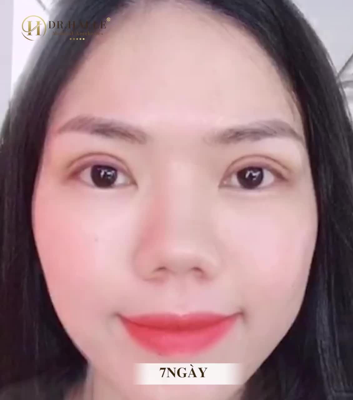 THỔI HỒN VÀO ĐÔI MẮT, BỪNG SÁNG KHUÔN MẶT chỉ sau 7 ngày Cắt mí!