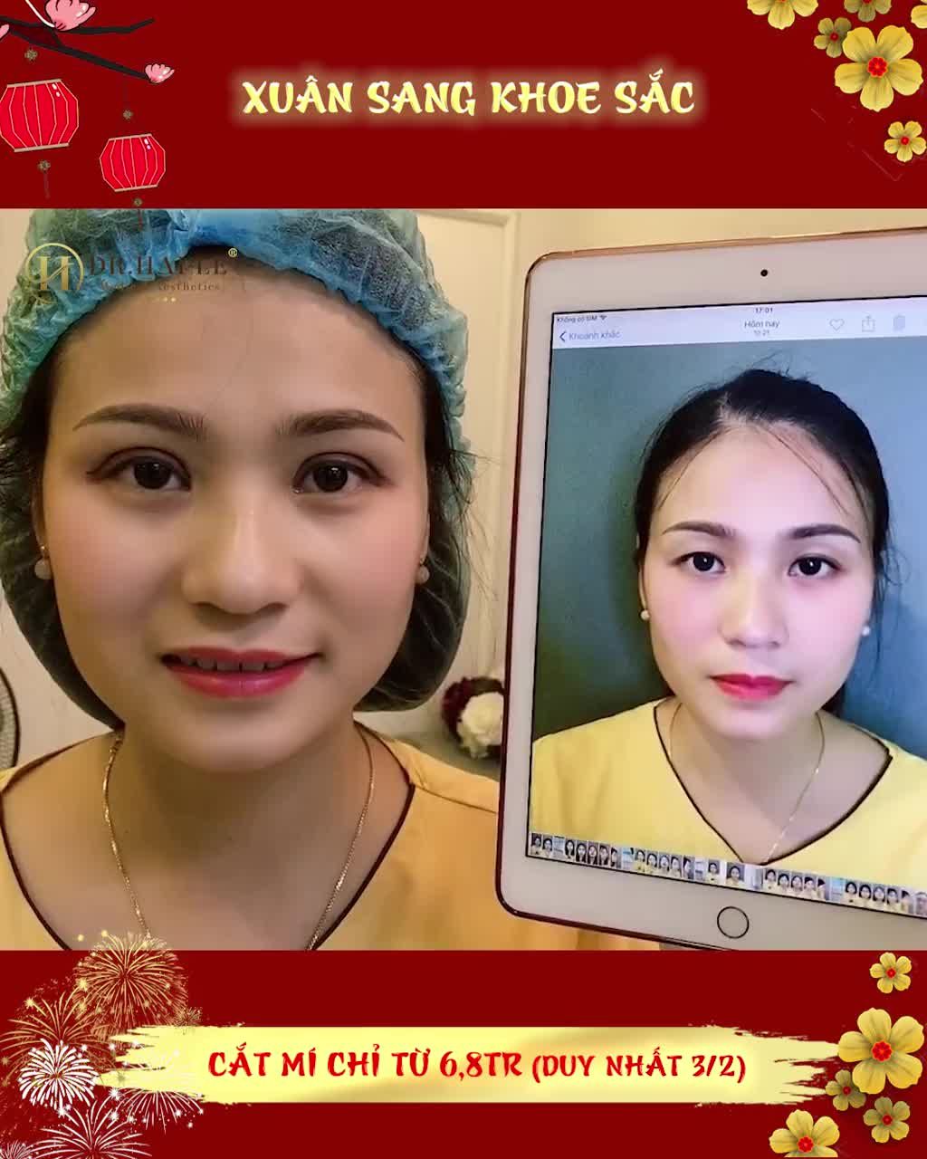 CẮT MÍ DOUBLE DEEP 5D - ĐẸP VÀ HƠN THẾ NỮA!