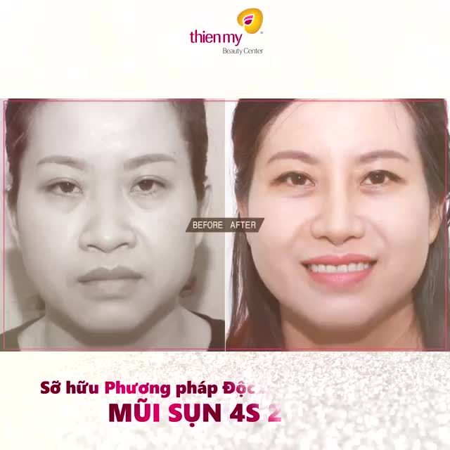 CÓ THỂ BẠN CHƯA BIẾT Nâng mũi bọc sụn 4S 2 lớp là như thế nào?