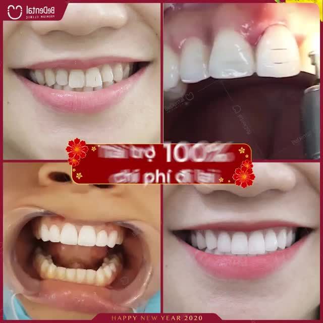 DÁN SỨ VENEER KHÔNG MÀI NHỎ - RĂNG BỀN ĐẸP TỚI 50 NĂM