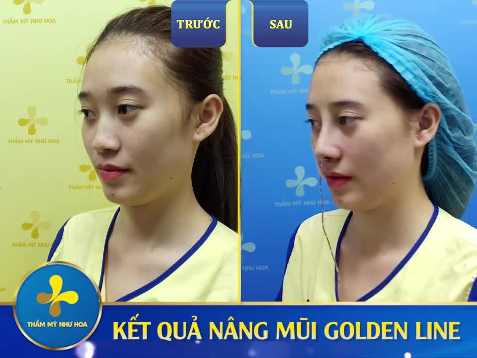 Kết quả ngay sau khi nâng mũi Golden Line ở 3 góc độ: Chính diện - Nghiêng trái - Nghiêng phải.