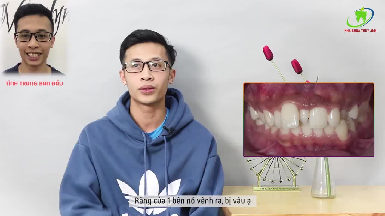 LÀM THẾ NÀO VỚI CHIẾC RĂNG MỌC KẸ BÂY GIỜ?