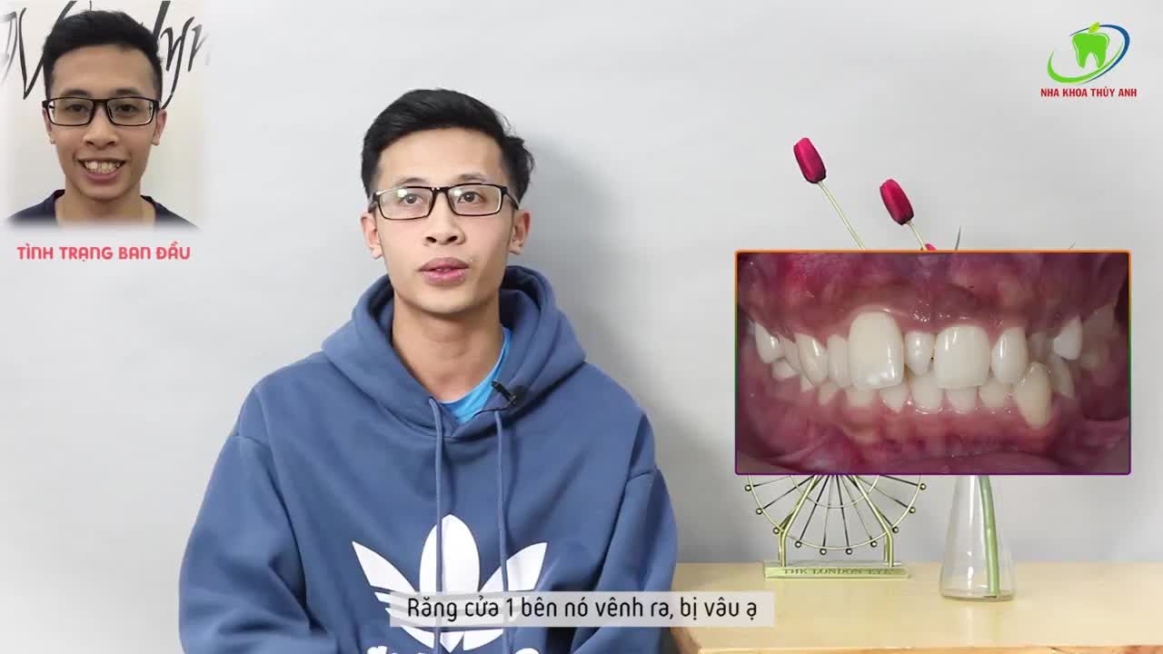 LÀM THẾ NÀO VỚI CHIẾC RĂNG MỌC KẸ BÂY GIỜ?