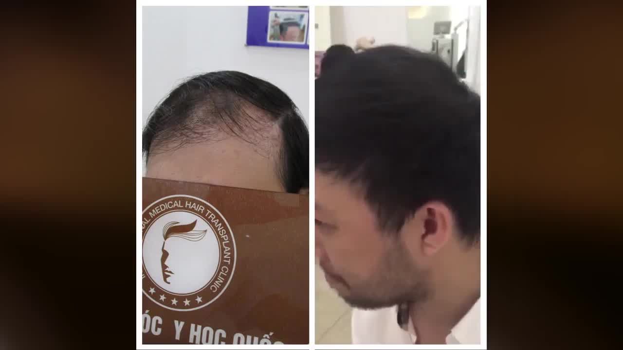 Trải nghiệm khách hàng phục hồi mái tóc sau 6 tháng thực hiện phương pháp cấy tóc tự thân.