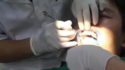 Case gắn mắc cài pha lê cho bệnh nhân N. Đ. H - 17 tuổi ở Hà Đông, Hà Nội.