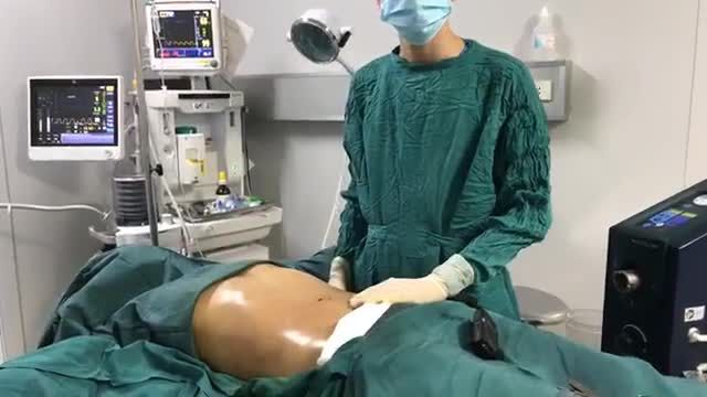 KẾT QUẢ CA HÚT MỠ TOÀN BỤNG bằng công nghệ BOODY JET được thực hiện tại bệnh viện.