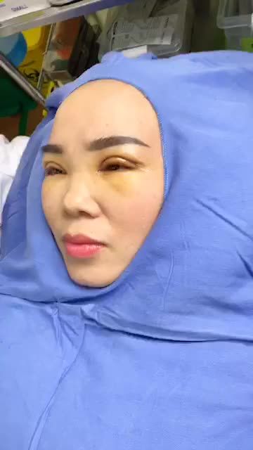 Cắt chỉ - Cắt mí Palasma - Nếp mí đẹp trong vòng 1 nốt nhạc