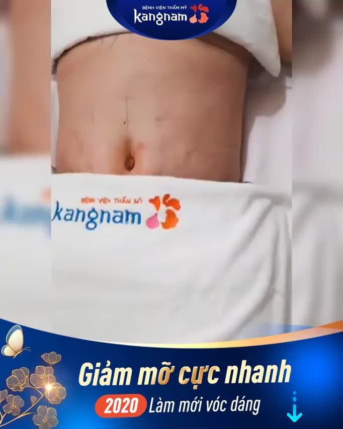 Vòng 2 QUÁ KHỔ vì mỡ cứng lâu năm + da chùng cấp độ 4