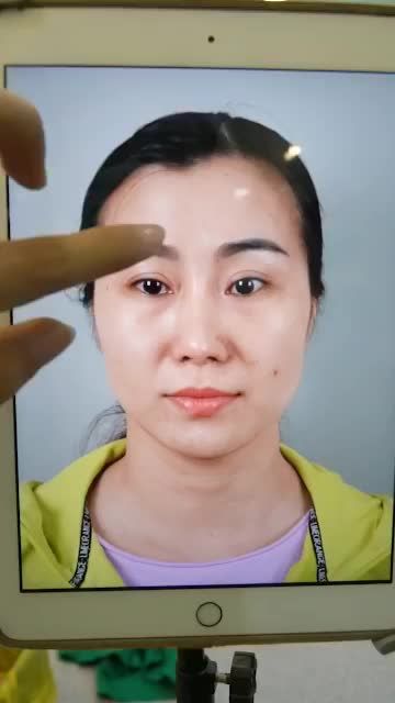 NÂNG MŨI CẤU TRÚC SỤN SƯỜN SỬA LẠI CHO KHÁCH ĐÃ 2 LẦN SỬA MŨI HỎNG TẠI NƠI KHÁC