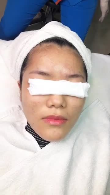 Điều trị mụn bằng công nghệ Nano Skin - Kết quả ngạc nhiên sau 6 buổi