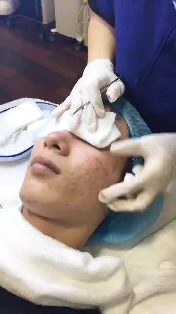 Da mụn khiến bạn mất tự tin đón Tết?