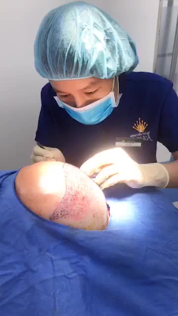 Cứu tinh cho tình trạng hói đầu lâu năm là đây !!