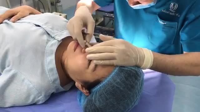 Ca mũi ngay tại phòng phẫu thuật lúc này