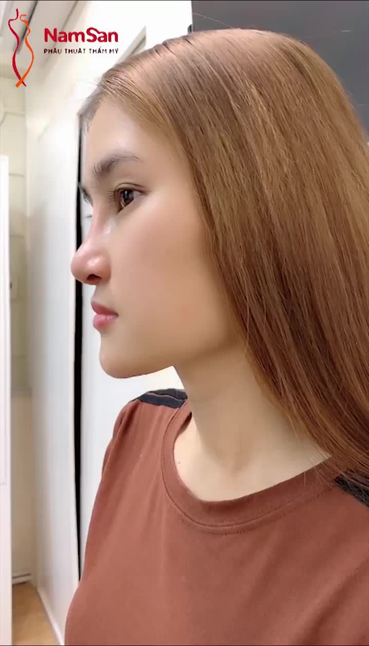 Ca nâng mũi cấu trúc xuất sắc của bác sĩ Thế cho khách hàng đẹp ăn Tết sau 14 ngày