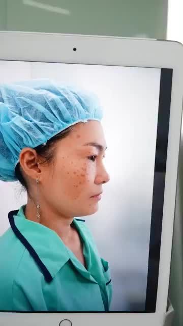 NÂNG MŨI BỌC SỤN VỪA THỰC HIỆN XONG