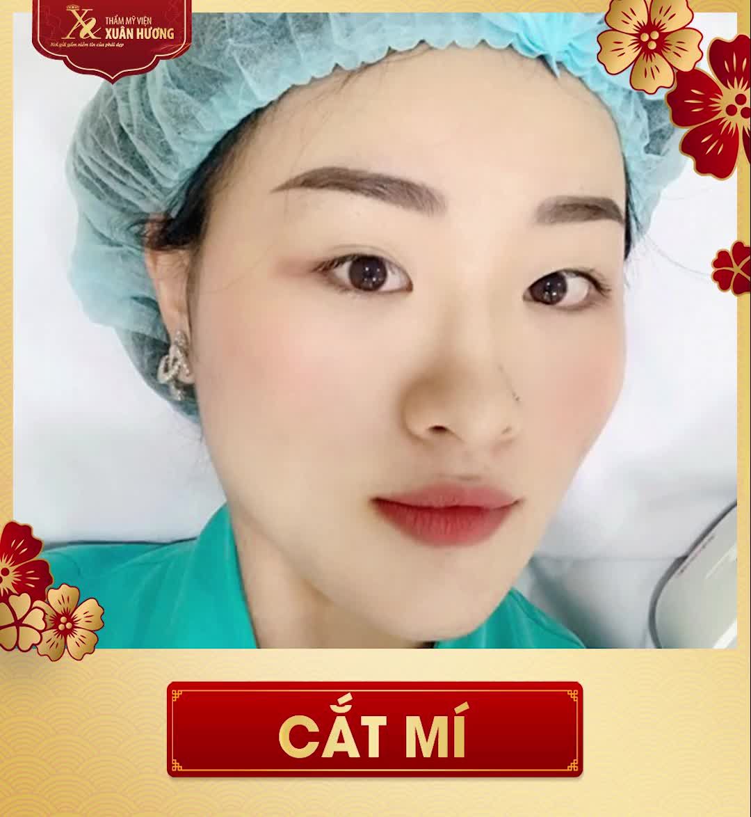 MẮT BIẾC TRÒN XINH - KỊP ĐẸP TRƯỚC TẾT CHỈ VỚI 5 NGÀY THẨM MỸ MẮT TẠI TMV XUÂN HƯƠNG