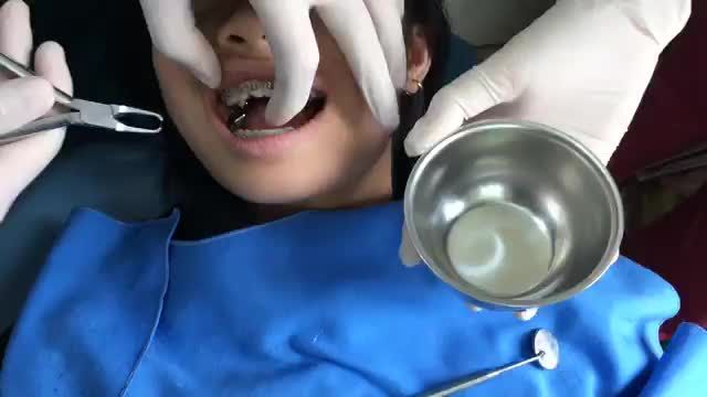 Tháo mắc cài cho bạn Hiền tại Nha Khoa Thuỳ Anh.