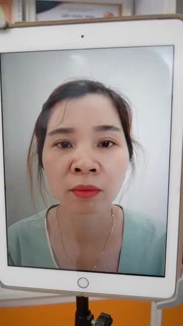 KẾT QUẢ NÂNG MŨI CẤU TRÚC SỤN SURGIFORM SAU 10 NGÀY