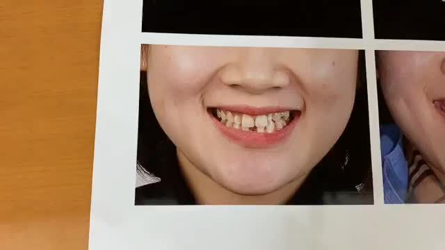 Gắn răng veneer cho chị Ngân tai Nha Khoa Thùy Anh.