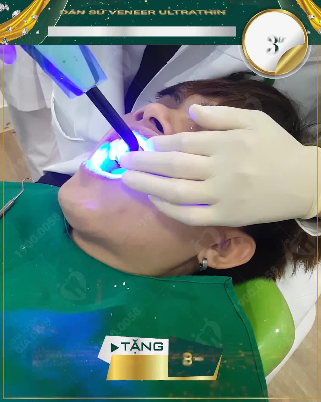 CẬN CẢNH QUÁ TRÌNH DÁN SỨ VENEER KHÔNG MÀI NHỎ RĂNG