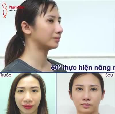 MŨI THẤP TẸT là chuyện hôm qua