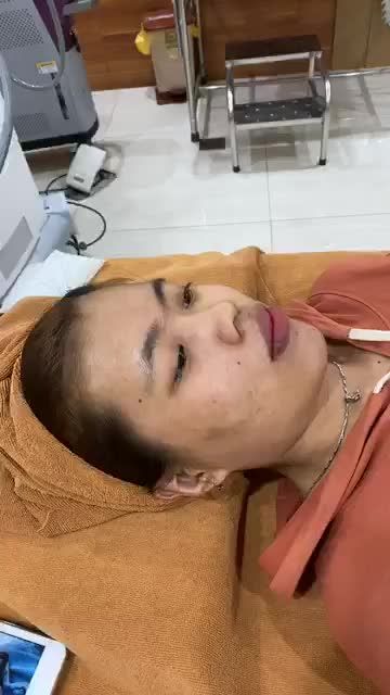 Điều trị u máu tại Dr Hoàng Tuấn với công nghệ laser Vbeam