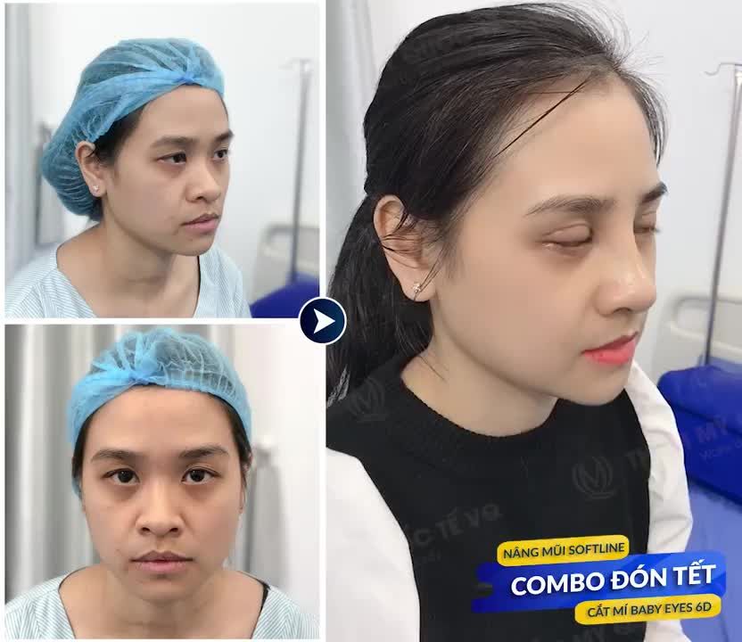 MŨI SOFTLINE + MÍ BABY EYES 6D đẹp sắc nét cho chị khách hàng về quê đón tết !