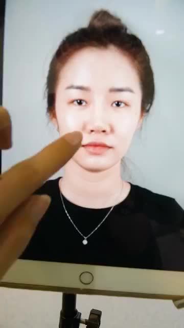 NÂNG MŨI CẤU TRÚC SỬA LẠI SAU LẦN ĐẦU NÂNG THẤT BẠI TẠI NƠI KHÁC