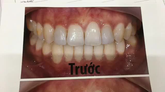 Gắn cố định răng sứ cho chị Quý Anh.