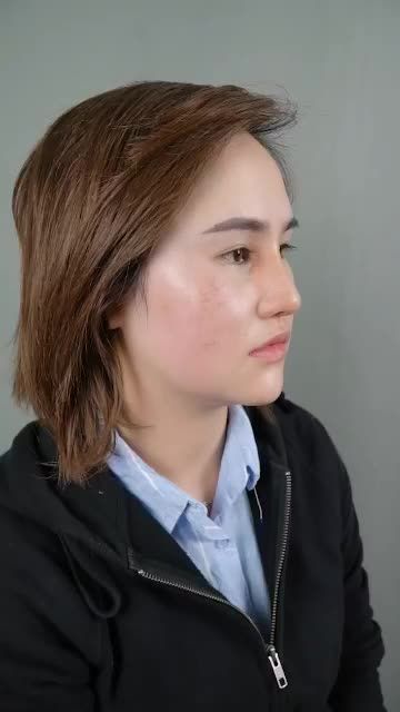 KẾT QUẢ SAU 10 NGÀY NÂNG MŨI TÁI KHÁM TẠI DR.HOẠT