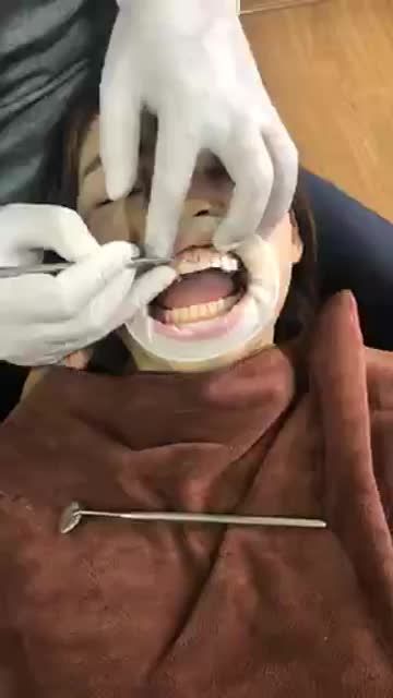 Quá trình lắp 4 mặt dán sứ Veneer điều trị khe thưa cho bạn nữ 19t