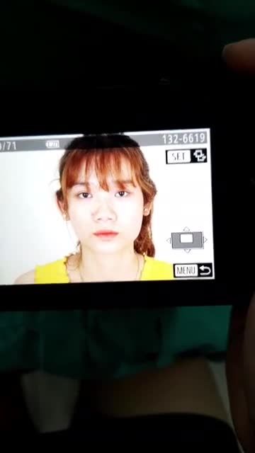 Phẫu thuật nâng mũi siêu cấu trúc cuộn cánh tại Thẩm Mỹ Viện Saigon Venus