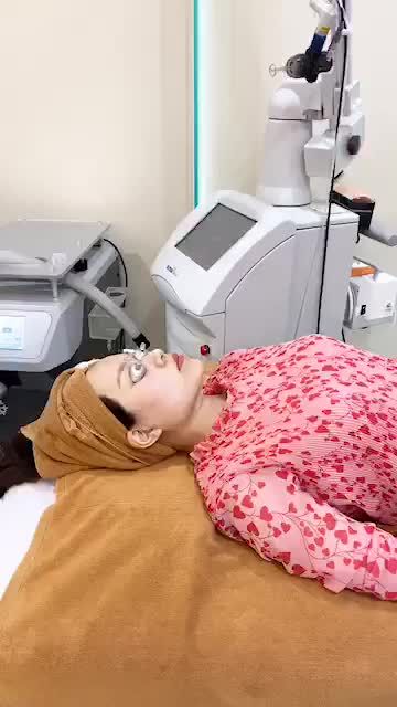 Sẹo rỗ - Sẹo lõm Khắc phục dễ dàng nhờ công nghệ Laser ULTRAPULE