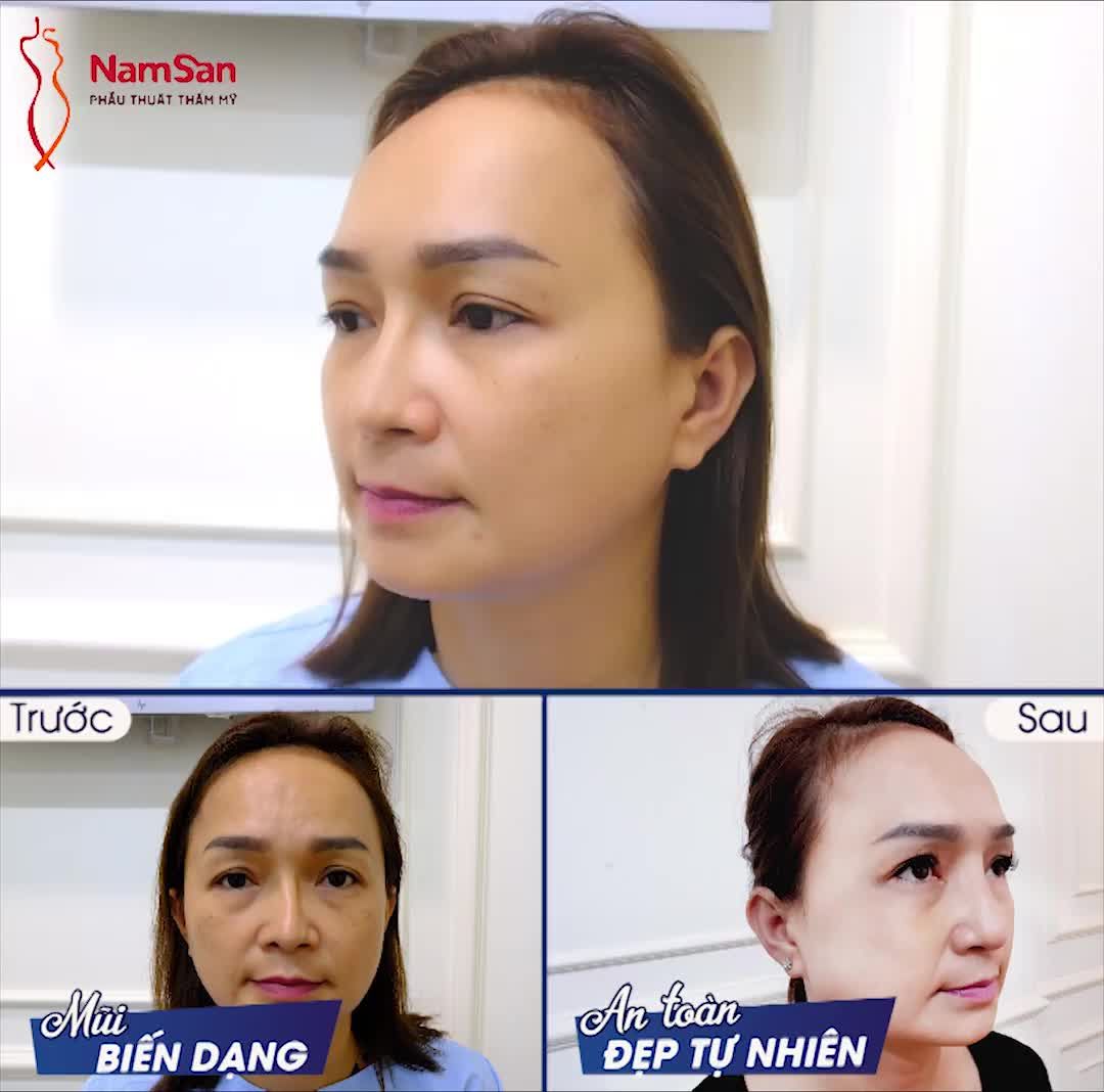 THAY ĐỔI MŨI HƯ - LỘT XÁC HOÀN TOÀN - ĐÓN TẾT TÀI LỘC