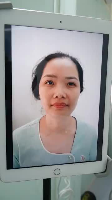 MŨI ĐẸP NGAY SAU KHI THỰC HIỆN