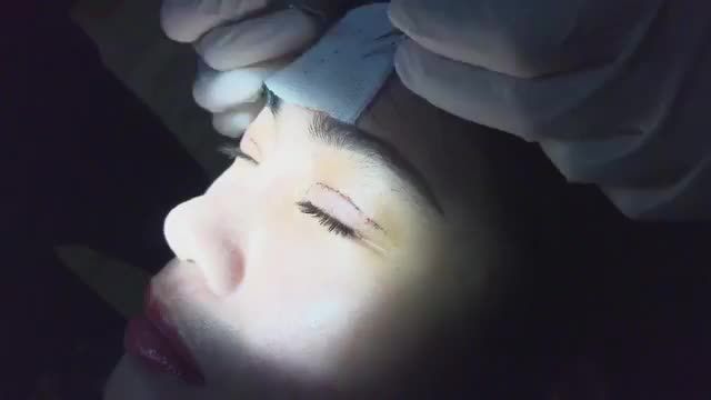 Cùng xem quy trình cắt chỉ sau 7 ngày cắt mí mani open deep 5d