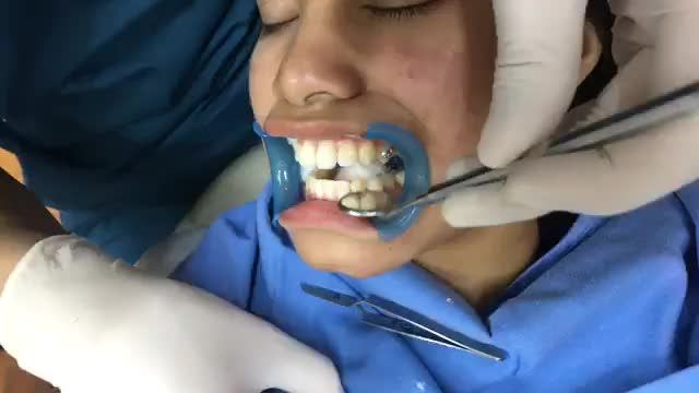 Gắn mắc cài tại Nha Khoa Thuỳ Anh.