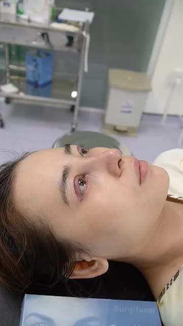 NÂNG MŨI CẤU TRÚC SURGIFORM KẾT HỢP CẮT MÍ MẮT VỪA THỰC HIỆN XONG