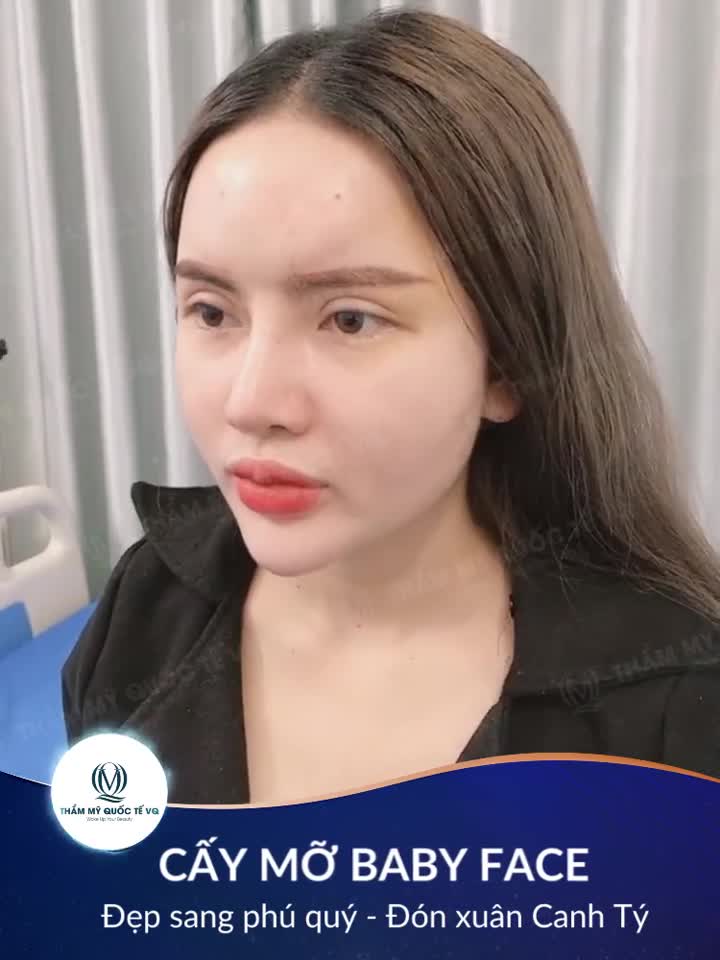 CẤY MỠ BABY FACE - ĐẸP PHÚ QUÝ - ĐÓN XUÂN CANH TÝ