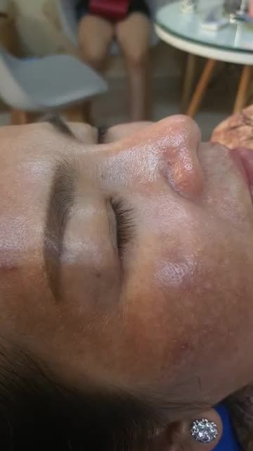 Nâng mũi bán cấu trúc 2 lớp