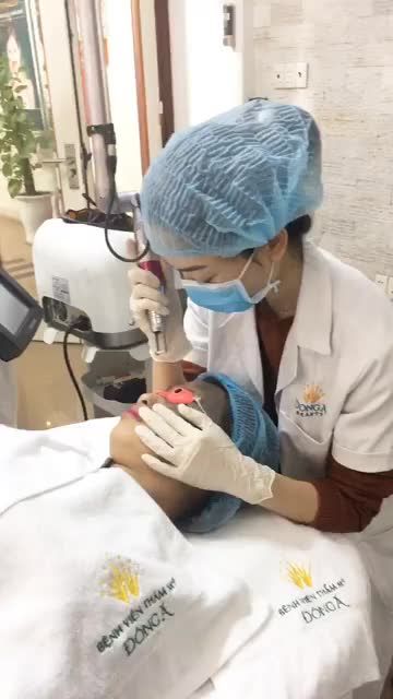 Quá trình xoá chàm bớt nửa mặt bằng Laser tại thẩm mỹ viện Đông Á Hải Phòng