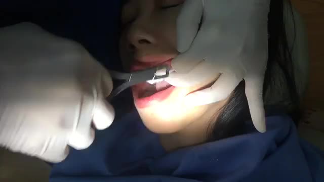 Tháo mắc cài cho bạn Nhi tại Nha Khoa Thùy Anh.
