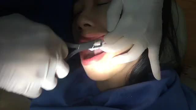 Tháo mắc cài cho bạn Nhi tại Nha Khoa Thùy Anh.