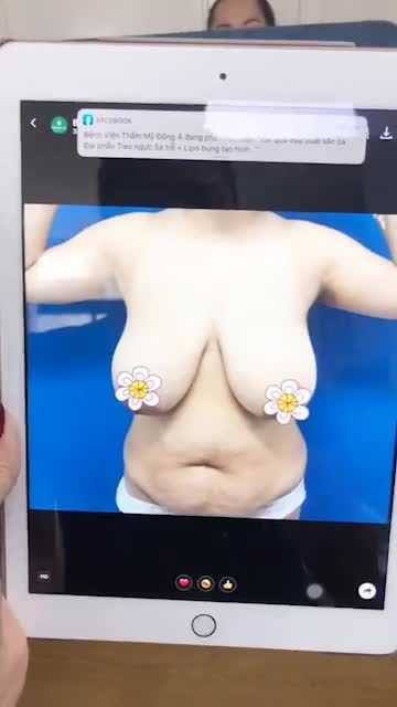 Kết quả đẹp xuất sắc ca Đại phẩu Treo ngực Sa trễ + Lipo bụng tạo hình Vòng Eo thon gọn , dáng đẹp sexy