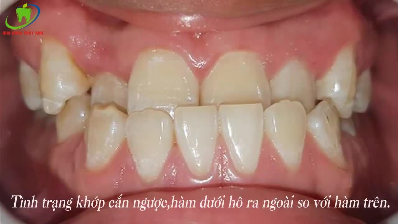 NIỀNG RĂNG THÙY ANH - SỰ LỰA CHỌN HOÀN HẢO CHO NỤ CƯỜI TƯƠNG LAI.