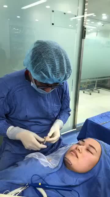 Mặt Vline thanh tú - Sau 30 PHÚT độn cằm tại Kangnam