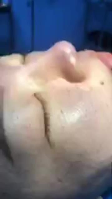 Nâng Mũi Bán Cấu Trúc 2 lớp cùng Bác Sĩ KỲ Y Dược Đẹp hoàn hảo sau 45 phút