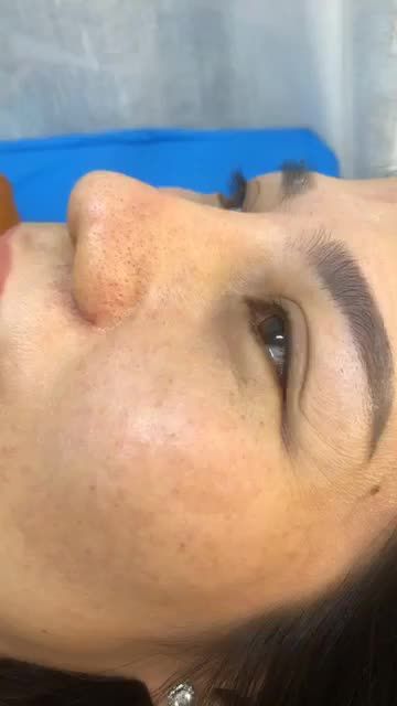 Mũi “Xênh” đón Tết Nâng mũi Bán Cấu Trúc 2 Lớp và cuộn cánh mũi Plasma.