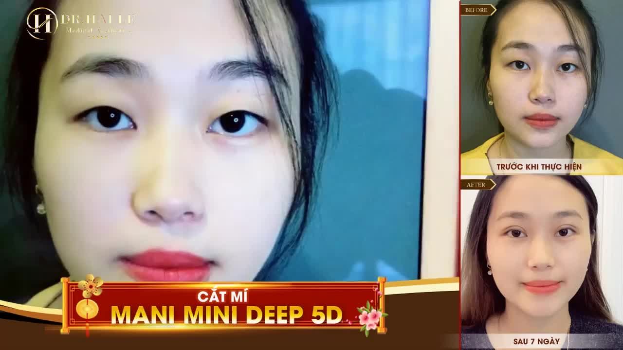 CẮT MÍ CÓ ẢNH HƯỞNG ĐẾN THỊ LỰC