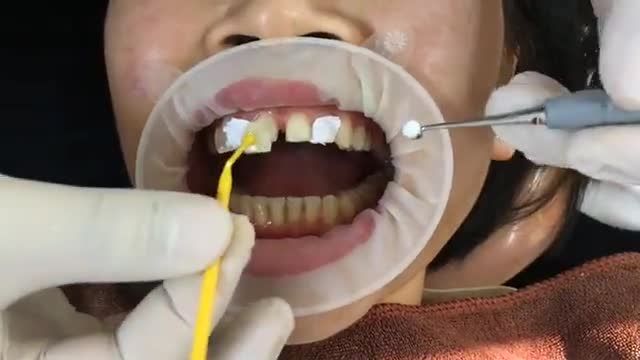 Mặt dán sứ veneer chữa răng thưa Răng hết thưa đón tết đón tài lộc